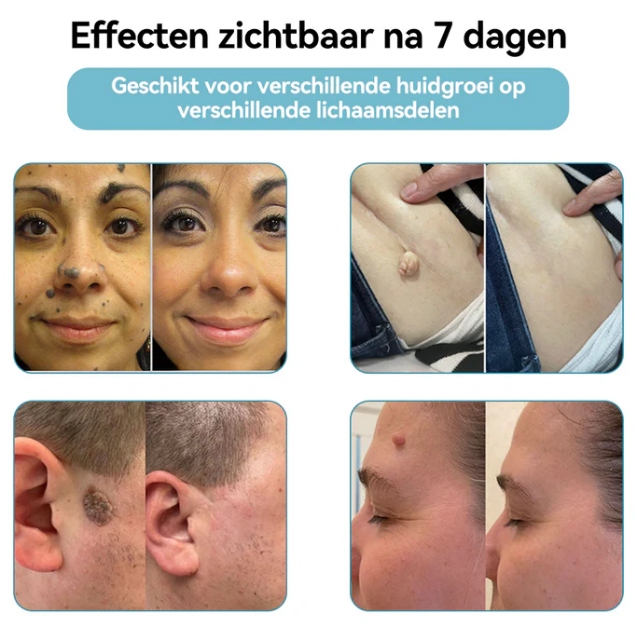 Caneta a laser Bikenda - EXTERMINADORA DE VERRUGAS