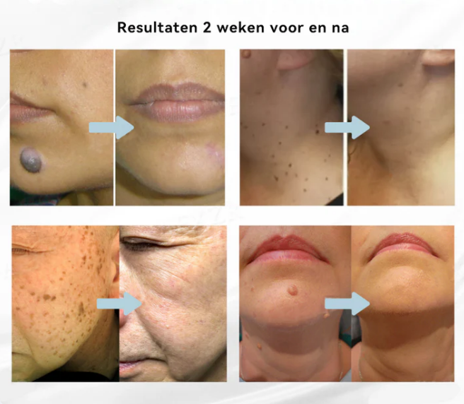 Caneta a laser Bikenda - EXTERMINADORA DE VERRUGAS