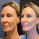 COLLAGEN FULLERENE - Sua pele 10 anos mais Jovem