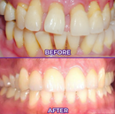 VIOLETX - CHEGA DE DENTES AMARELADOS