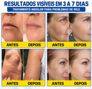 Tratamento Antirrugas com Botox e PDRN – Creme Lifting e Firmador