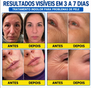 Tratamento Antirrugas com Botox e PDRN – Creme Lifting e Firmador