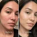 PLUNÉA - O FIM DAS MARCAS E MANCHAS CAUSADAS PELA ACNE