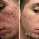 PLUNÉA - O FIM DAS MARCAS E MANCHAS CAUSADAS PELA ACNE
